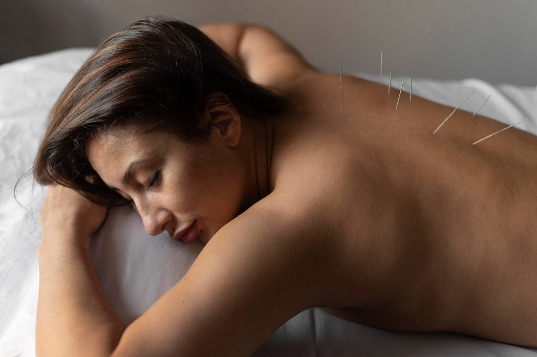 Acupuncture needle therapy
