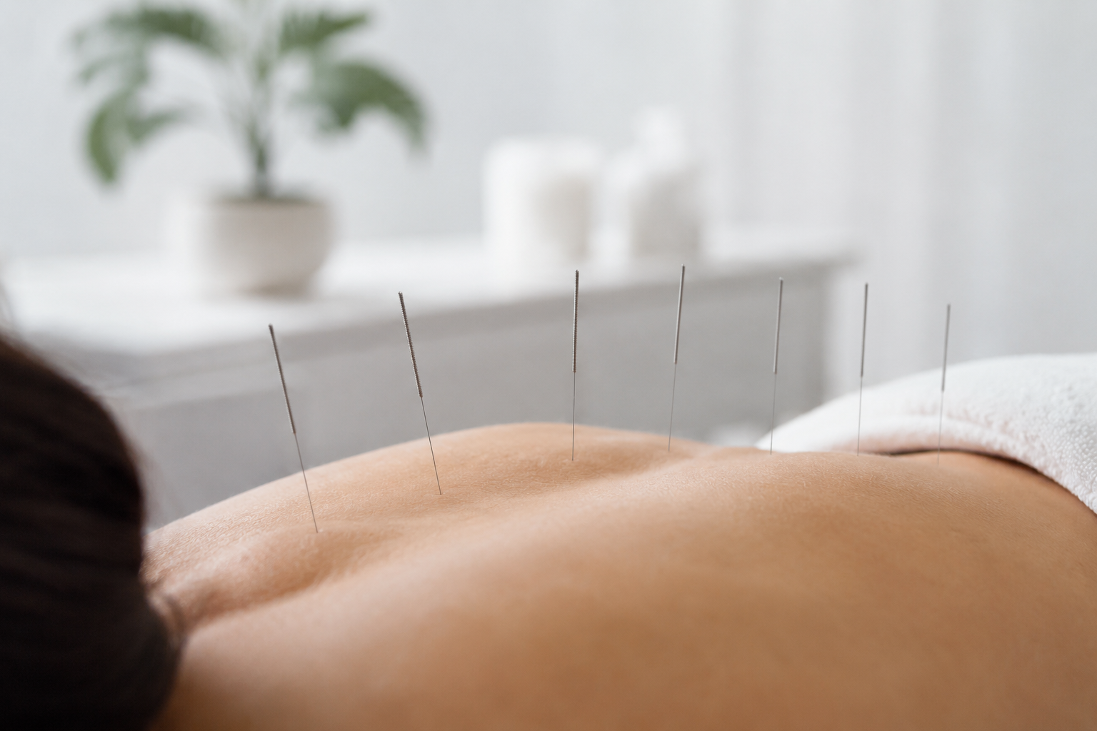 Acupuncture needles